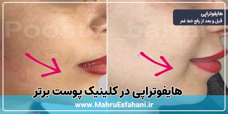 خدمات هایفوتراپی در کلینیک پوست برتر اصفهان