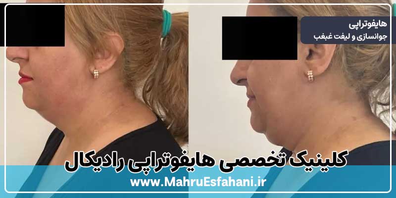 خدمات هایفوتراپی در کلینیک زیبایی رادیکال
