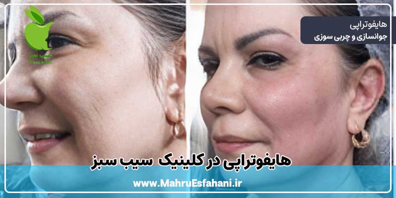 خدمات هایفوتراپی در کلینیک سیب سبز اصفهان