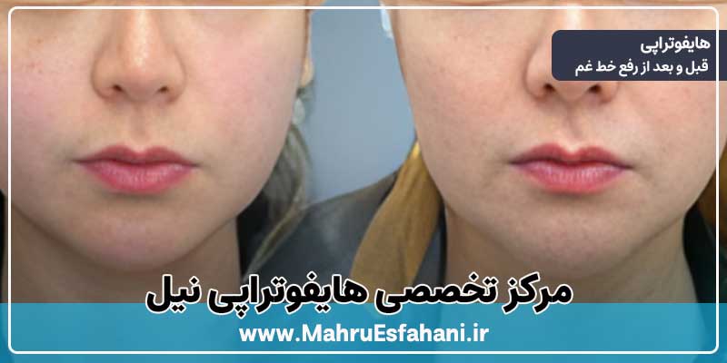 خدمات هایفوتراپی در کلینیک نیل اصفهان