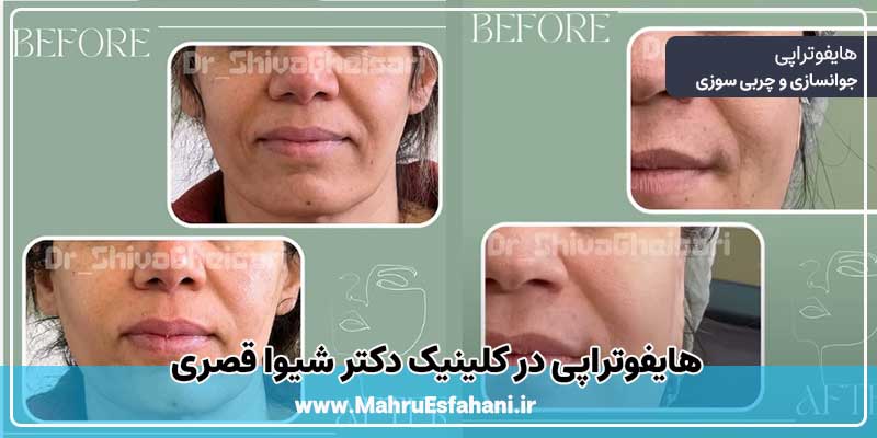 هایفوتراپی در اصفهان در کلینیک زیبایی دکتر شیوا قصری