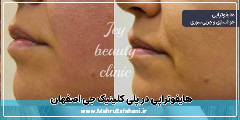 هایفوتراپی در اصفهان در کلینیک تخصصی جی