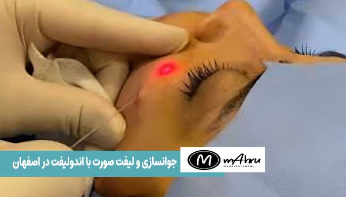 خدمات جوانسازی با اندولیفت در اصفهان